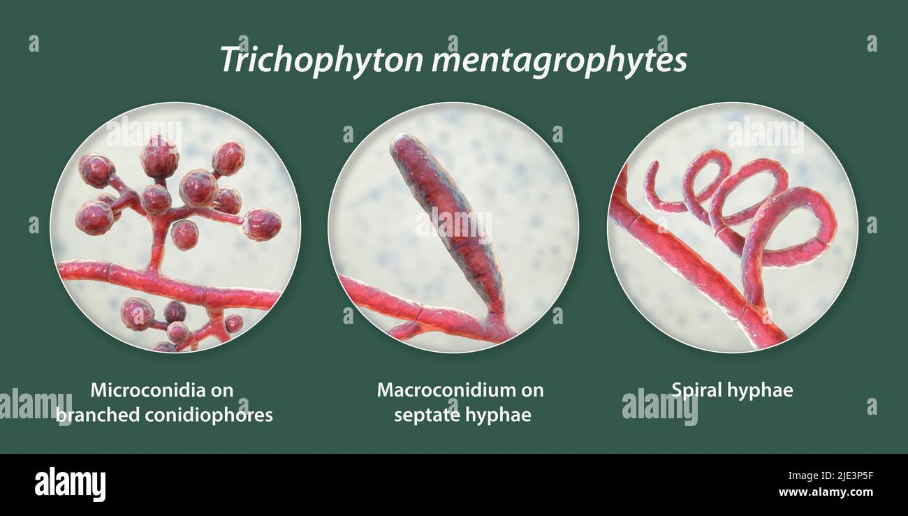 Fungi Trichophyton mentagrophytes, the cause of athlete's foot (tinea pedis), scalp ringworm (tinea capitus), and nail infection (onychomycosis), illu Stock Photo
