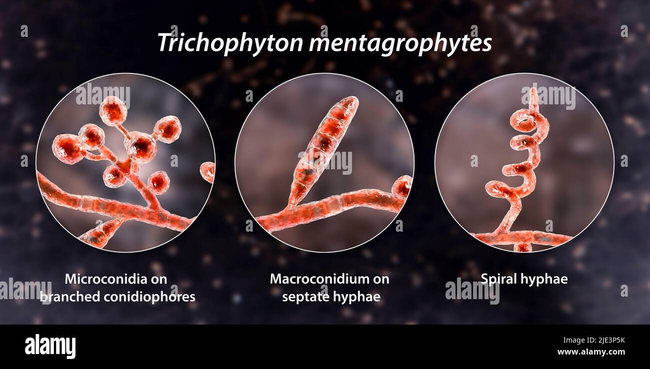 Fungi Trichophyton mentagrophytes, the cause of athlete's foot (tinea pedis), scalp ringworm (tinea capitus), and nail infection (onychomycosis), illustration. T. mentagrophytes is one of many species of fungi that can grow in human skin, causing inflammation and itching. Athlete's foot, ringworm and onychomycosis are treated with antifungal drugs. Illustration shows two types of conidia (structures which contain fungal spores that transmit infections): branched conidiophores bearing spherical microconidia (unicellular bodies), macroconidium (multicellular body), and spiral hyphae. Stock Photo