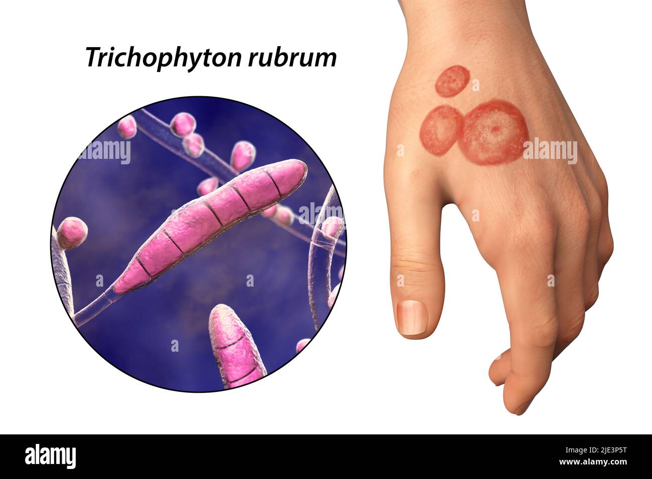 Fungal infection on a man's hand, illustration. Known as ringworm infection, or tinea manuum. It can be caused by various fungi, including Trichophyton rubrum. It causes severe itching. The disease is highly contagious, and can be spread by direct contact or by contact with contaminated material. Treatment is with antifungal drugs. Stock Photo