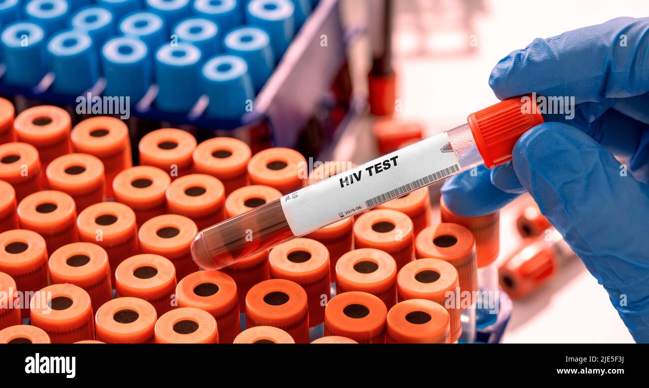 HIV Test tube with blood sample in infection lab Stock Photo
