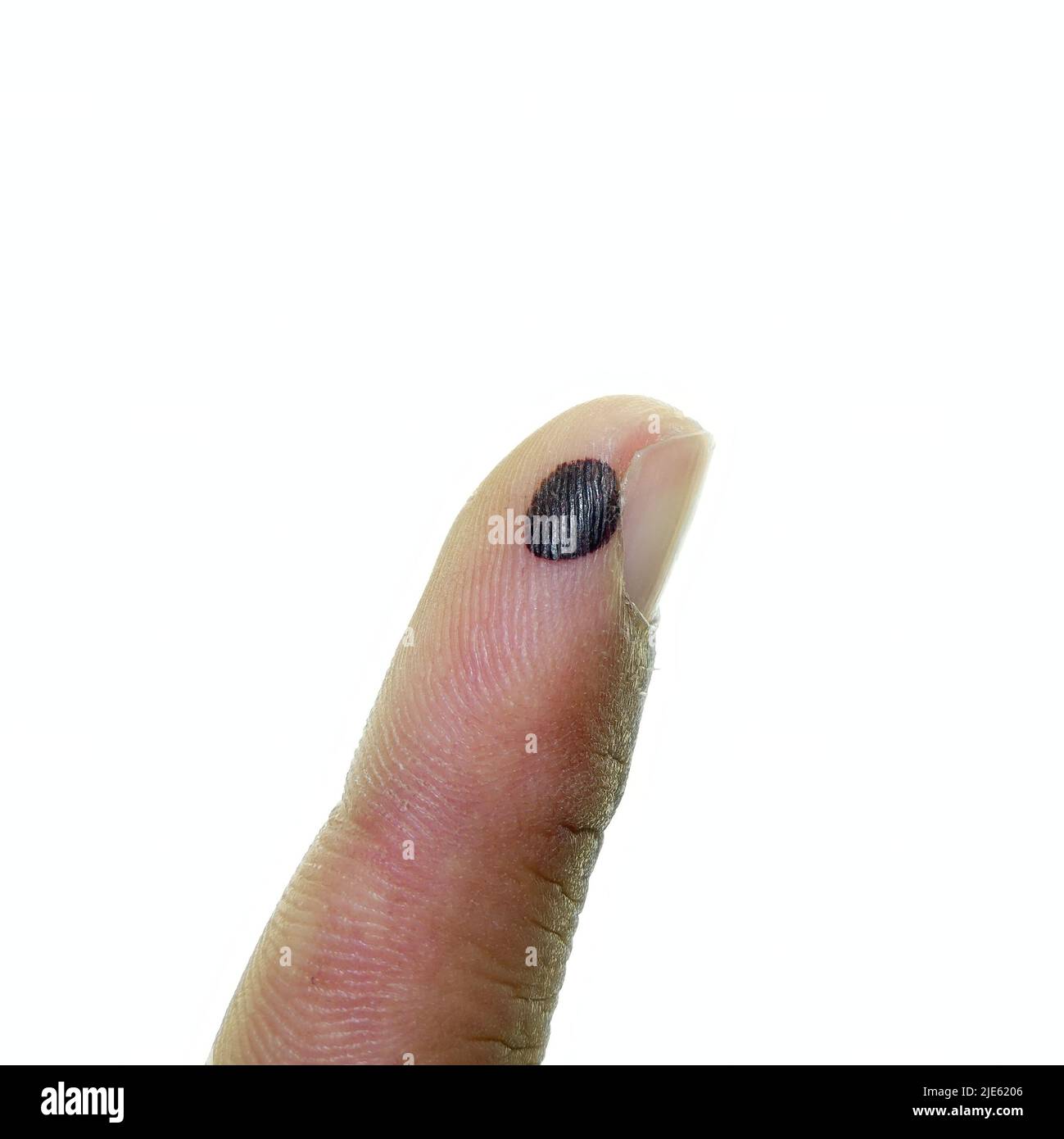 Subcutaneous hematoma close up hi-res stock photography and images - Alamy