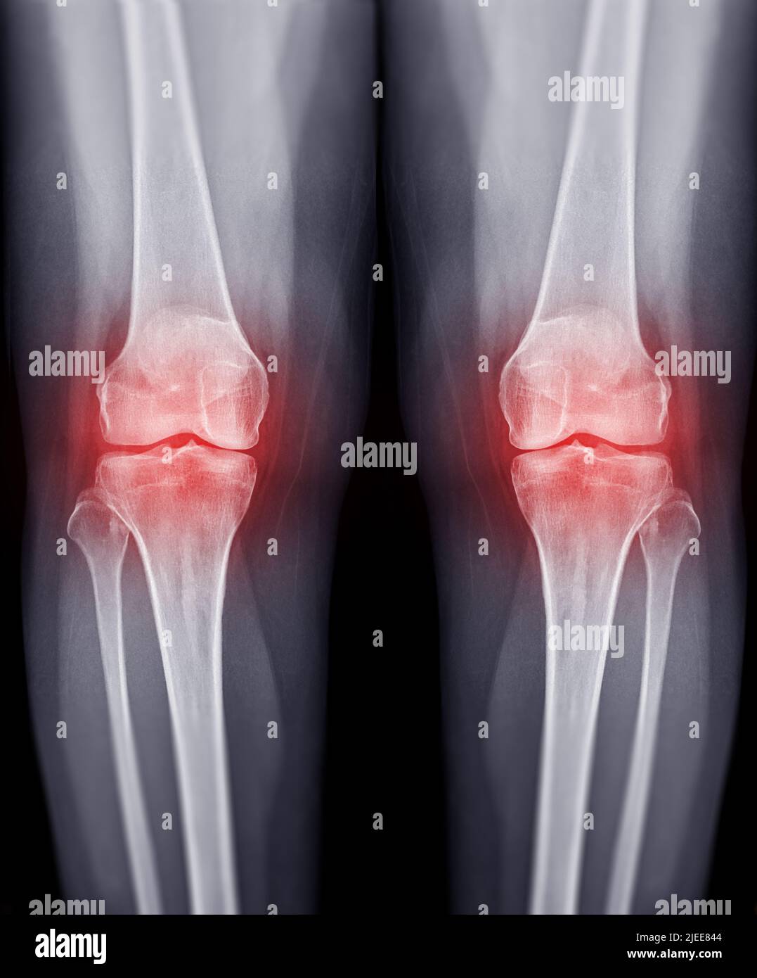 Ankle Effusion X Ray ankle-effusion-x-ray