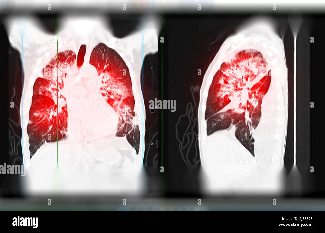 Lung ct scan hi-res stock photography and images - Alamy
