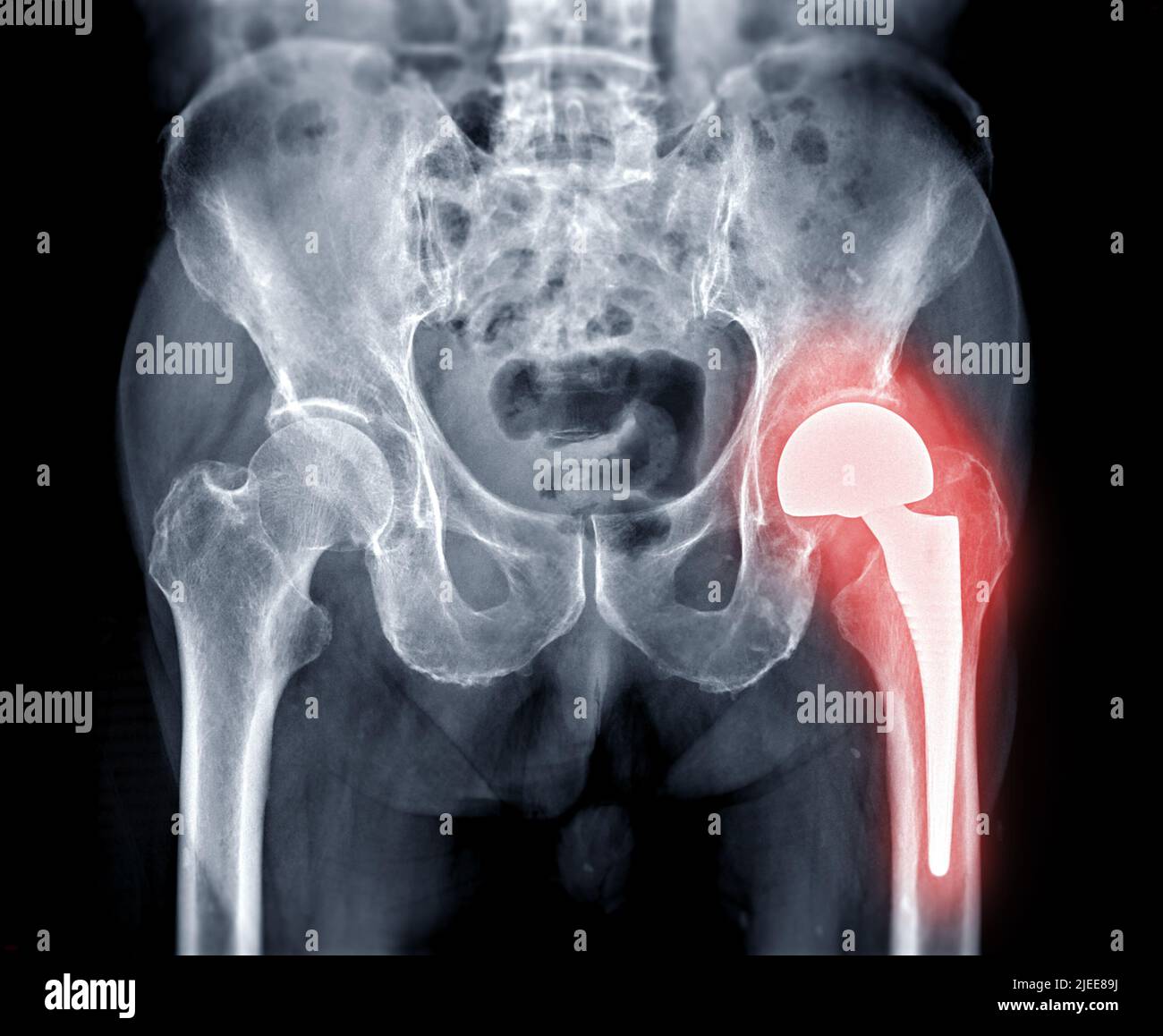 Xray pelvic bone or both hip joint after total hip replacement
