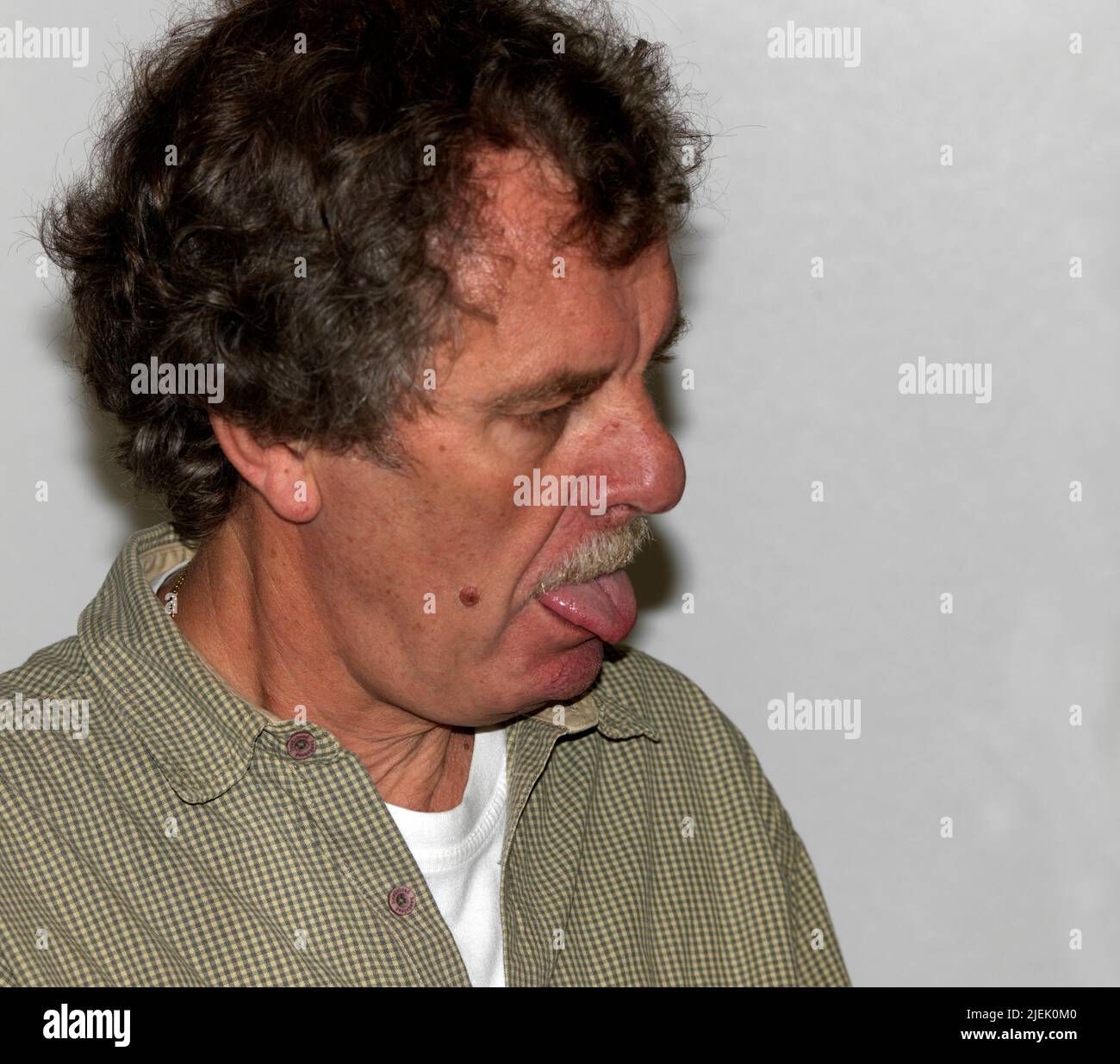 Man suffering from Neurological Disorder Tardive dyskinesia Causing Involuntary Movements in the