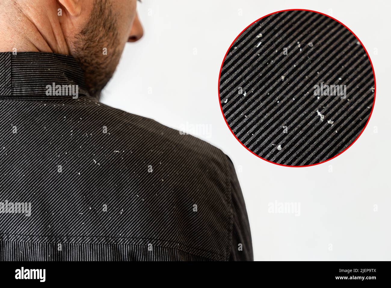 A bearded man in a black shirt, a close up view of the shoulder covered with dandruff. White background with zoomed dander. The concept of psoriasis a Stock Photo