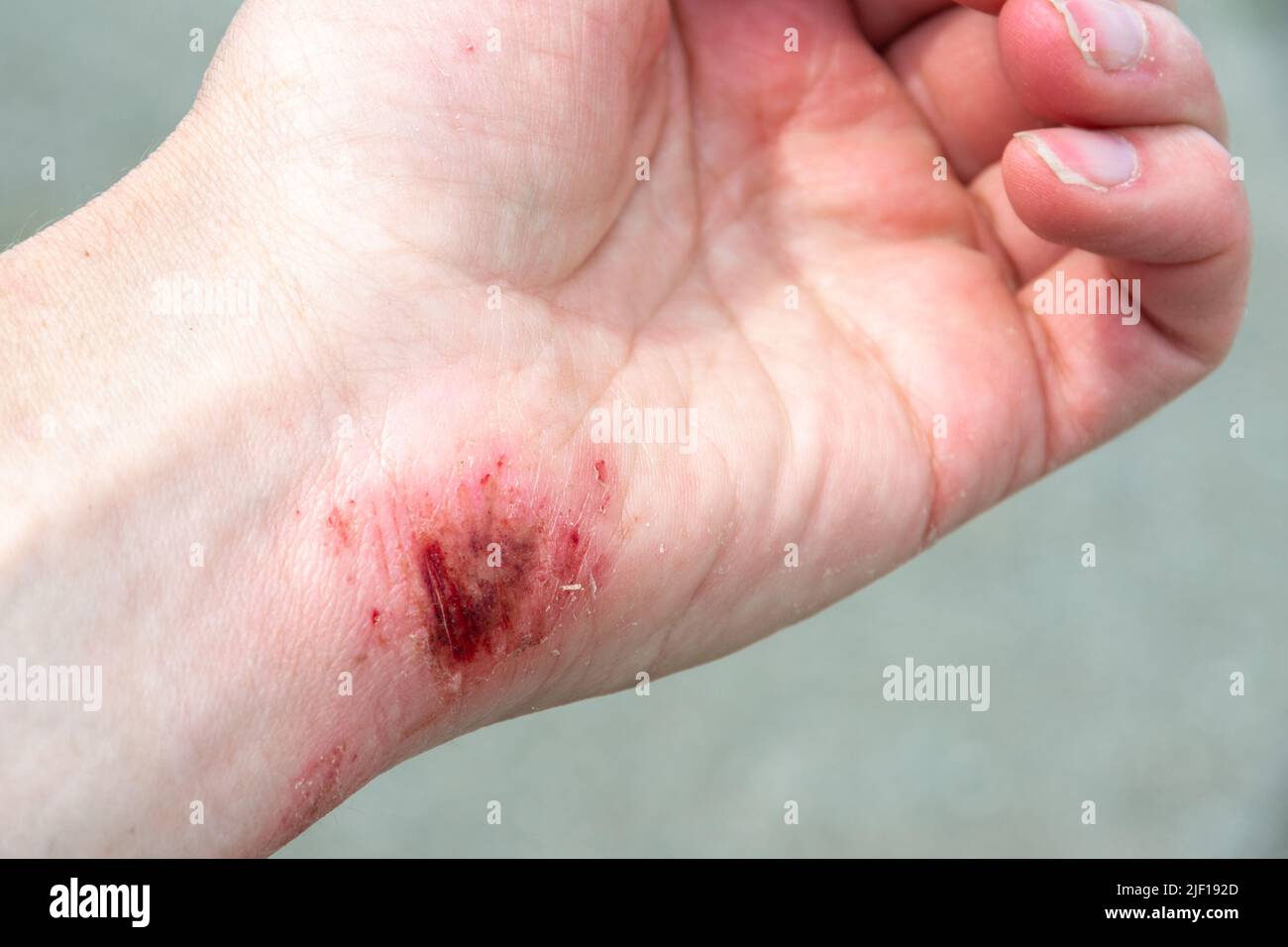 Red wound on the palm, arm, wrist after a burn or fall. First aid in