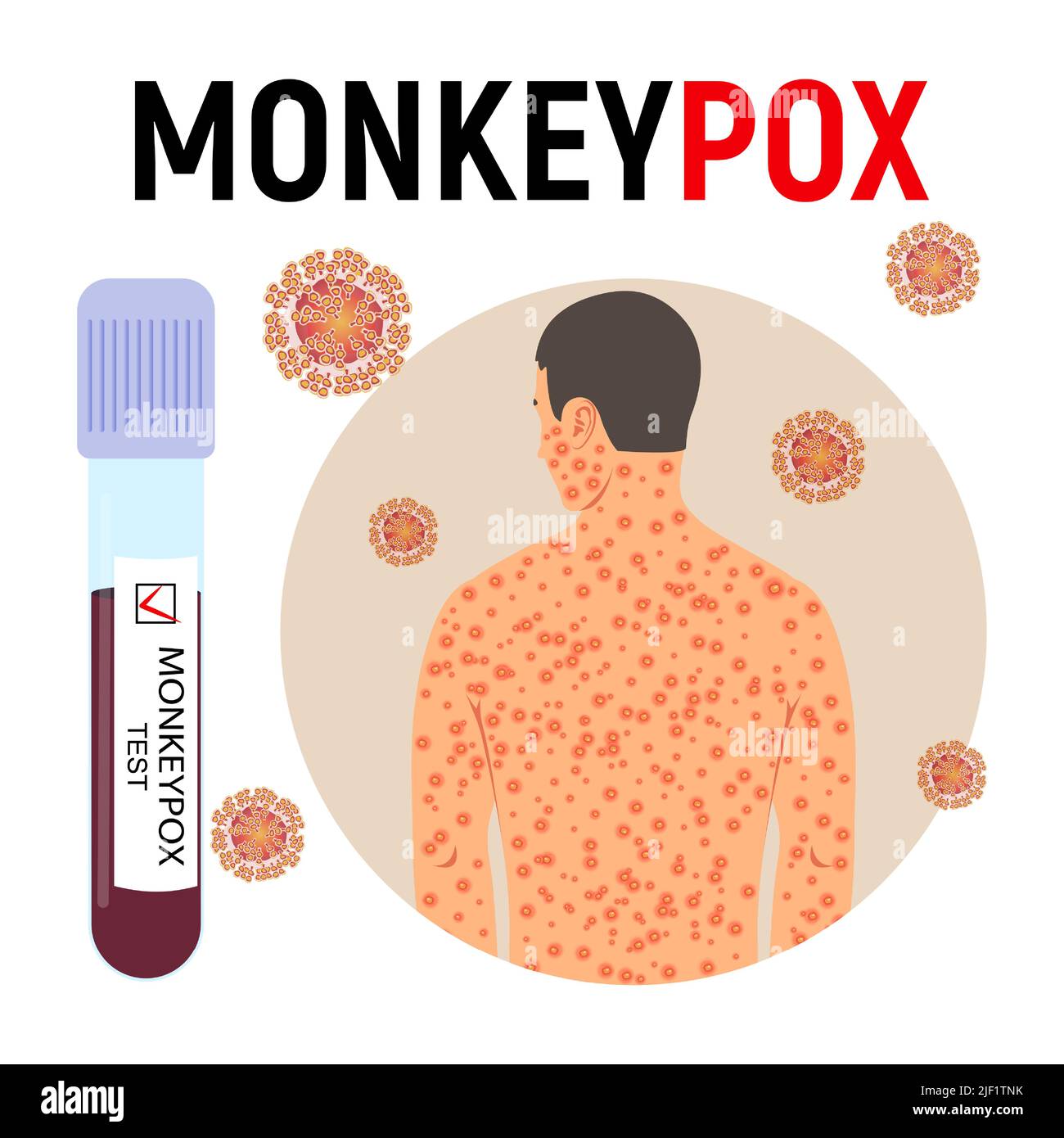 Monkeypox pandemic poster. Smallpox man, test tube with blood with a positive test and virus cells. Viral disease. Vector illustration. Stock Vector