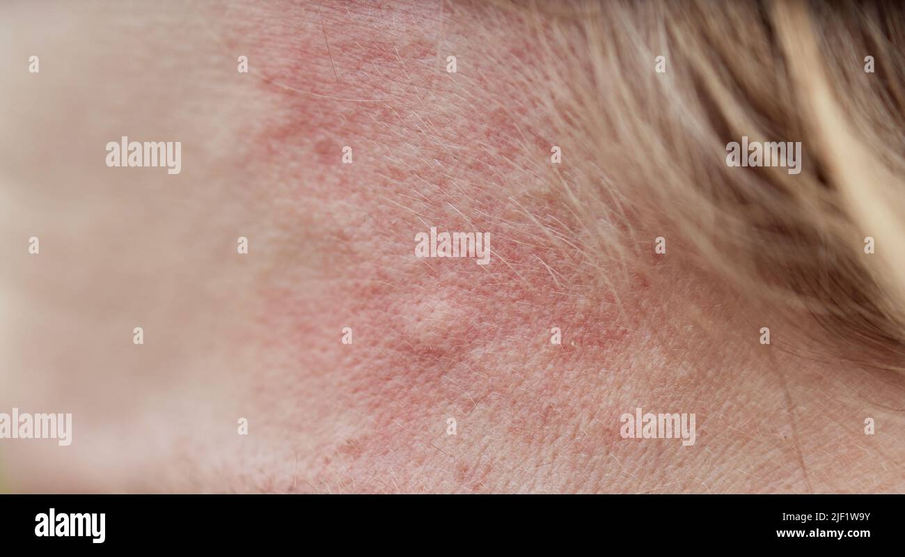 Bite mark, sting or sore on human skin. Close up of symptoms