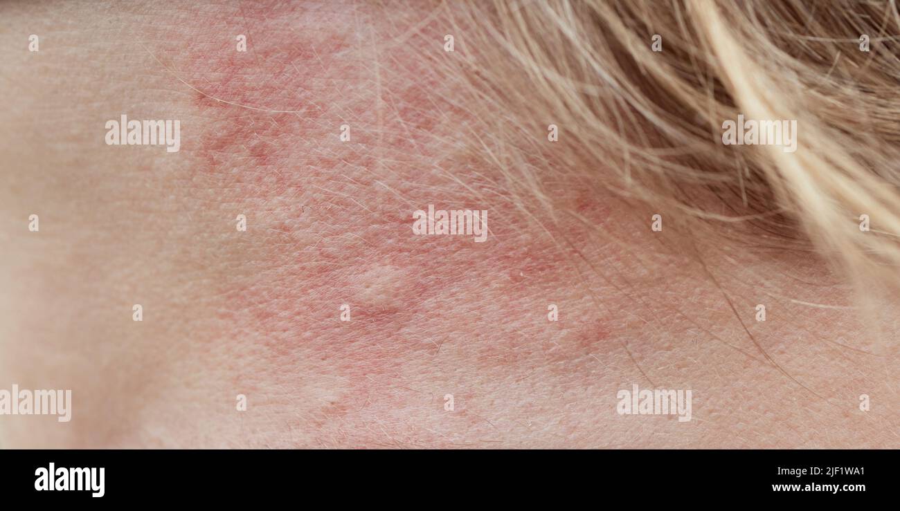 Bite mark, sting or sore on human skin. Close up of symptoms