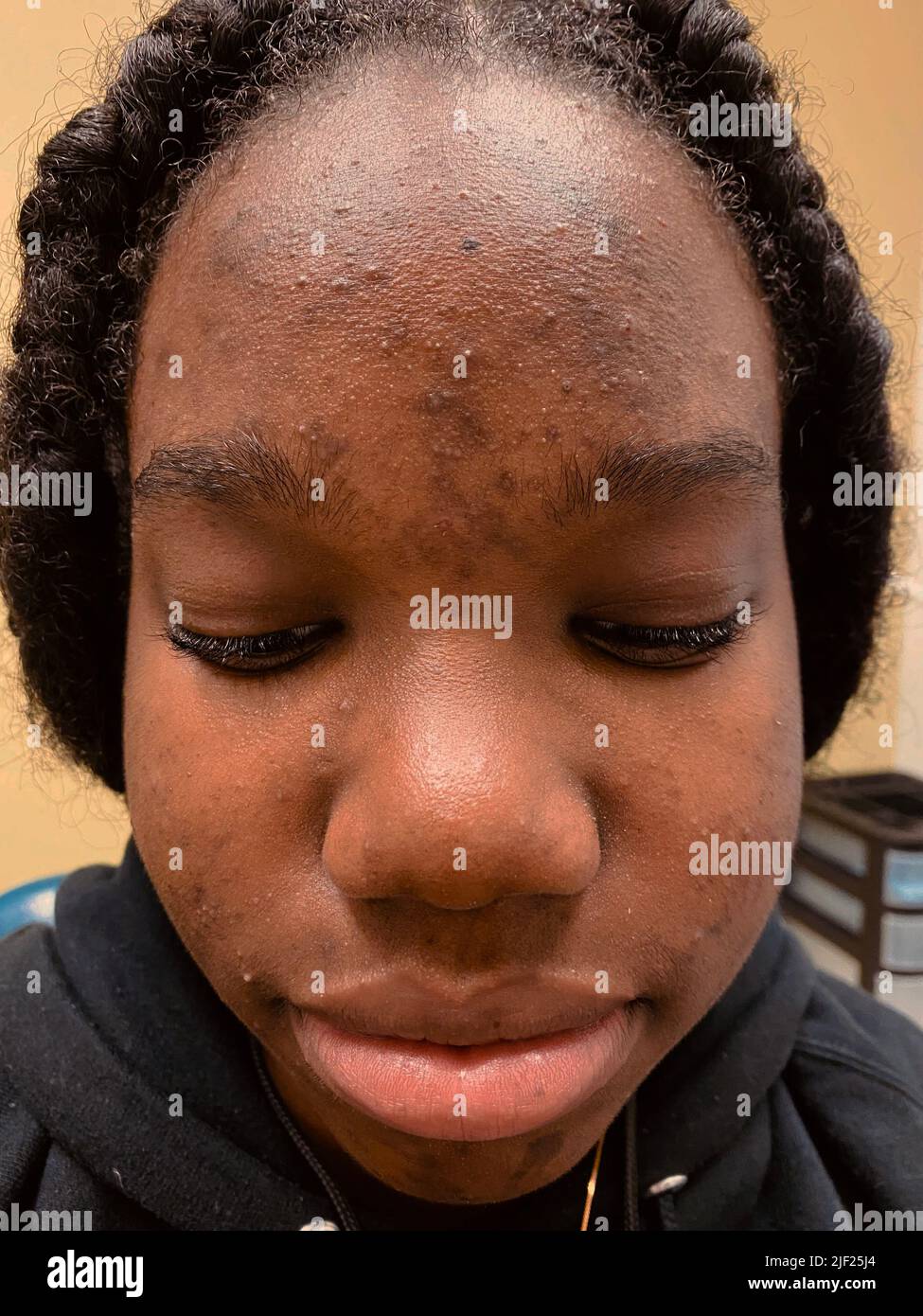 Acne from outlet hair products