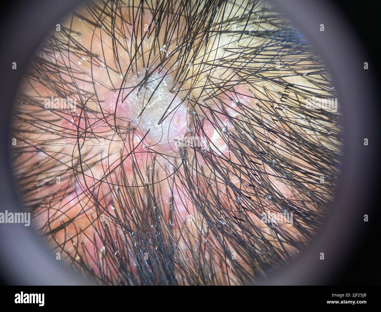 576 Infection Inflammation Hair Follicles Images Stock Photos  Vectors   Shutterstock