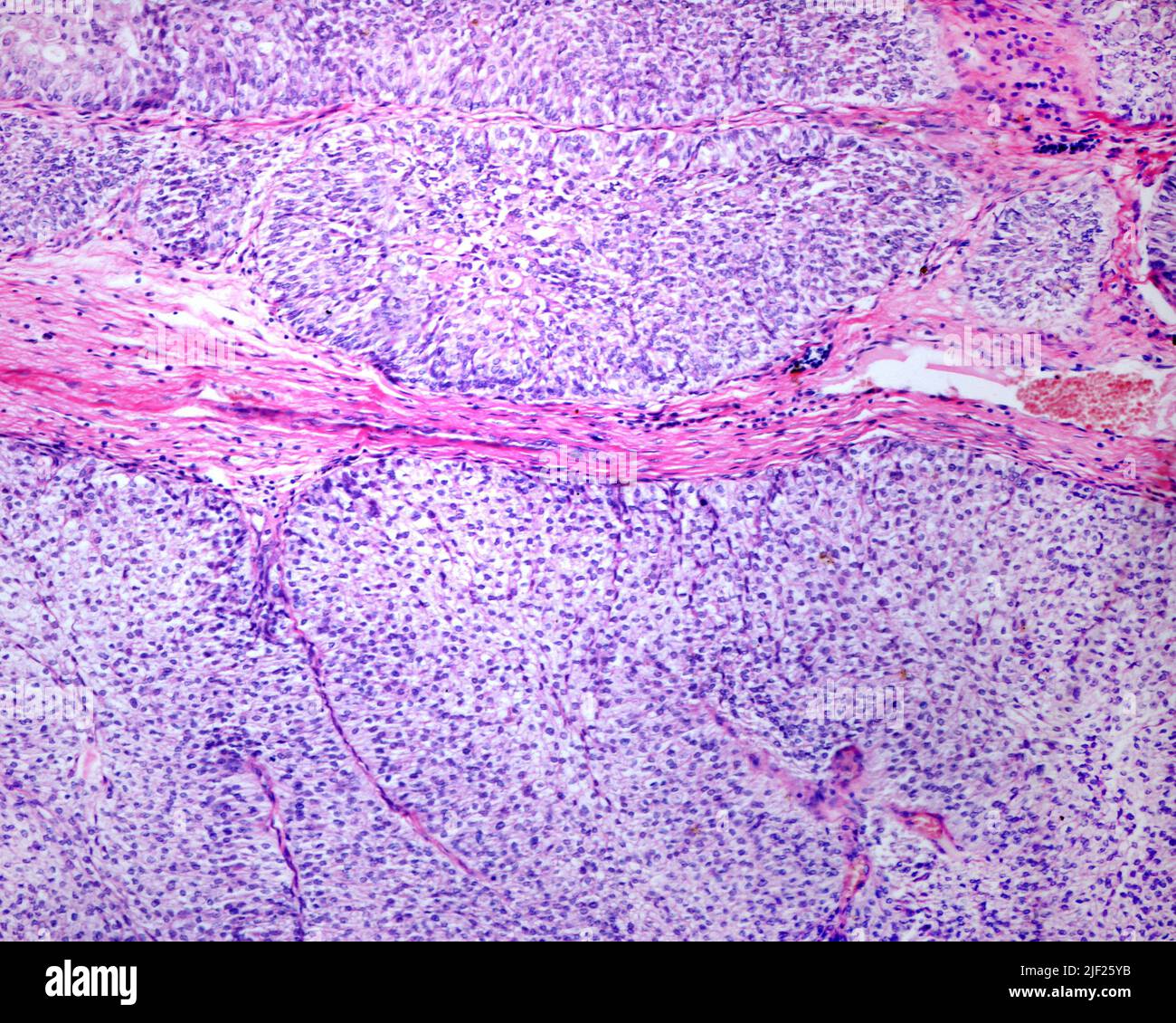 Papillary Carcinoma