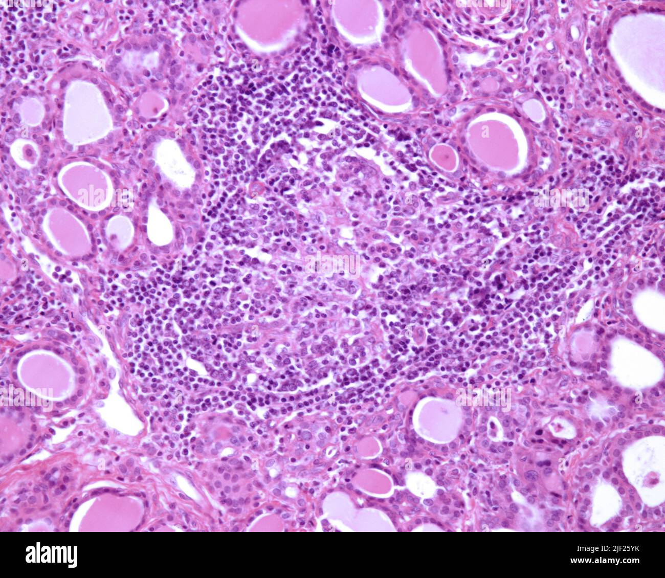 Tiroiditis Light micrograph of a human thyroid with chronic thyroiditis (Hashimoto ...