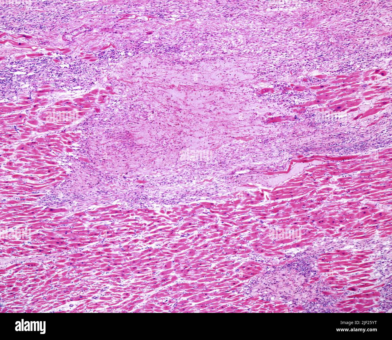 Light Micrograph Of A Fibrotic Scar From An Old Myocardial Infarct In A 