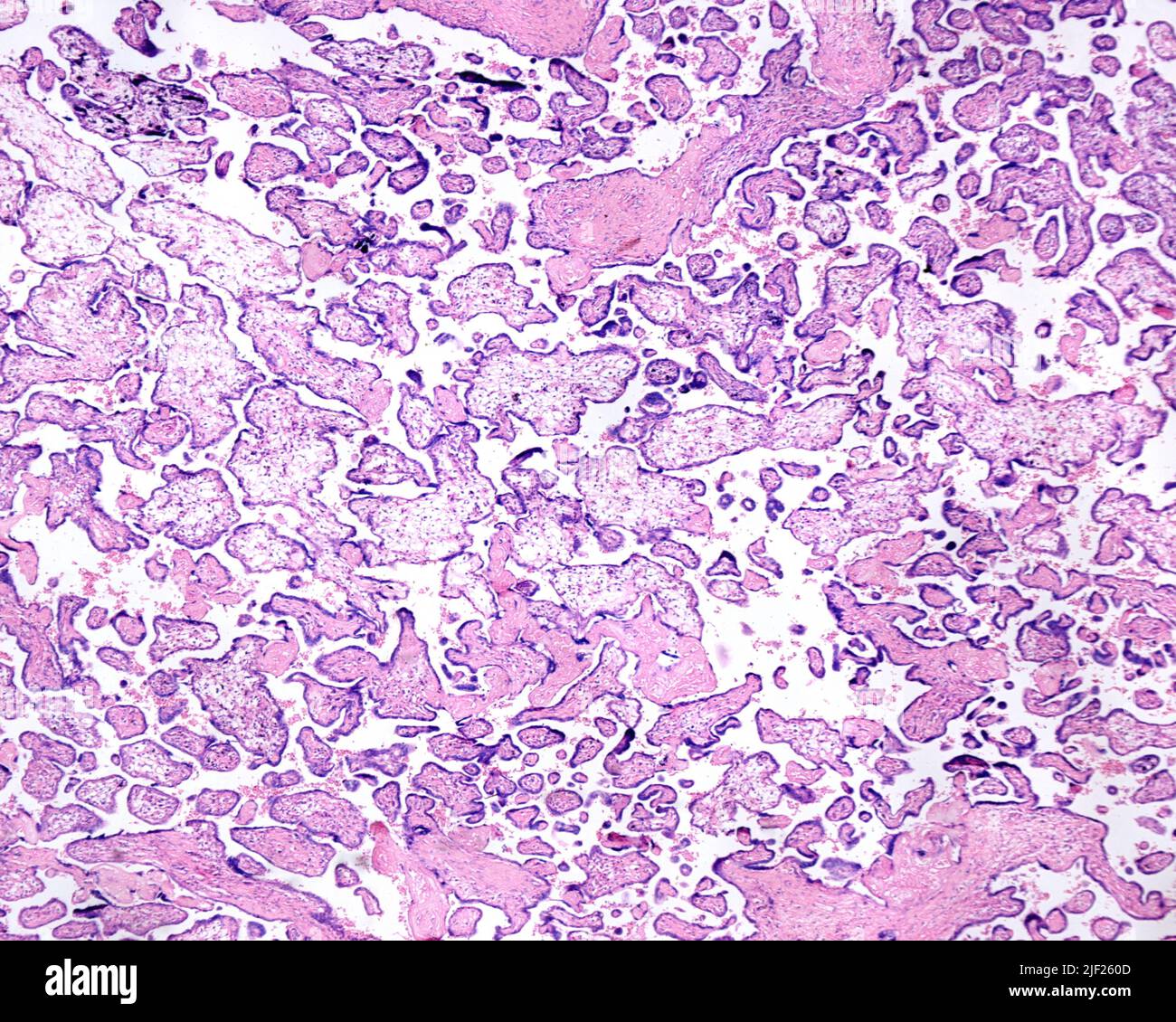 Human placenta. Erythroblastosis fetalis. Seen is a placental villus