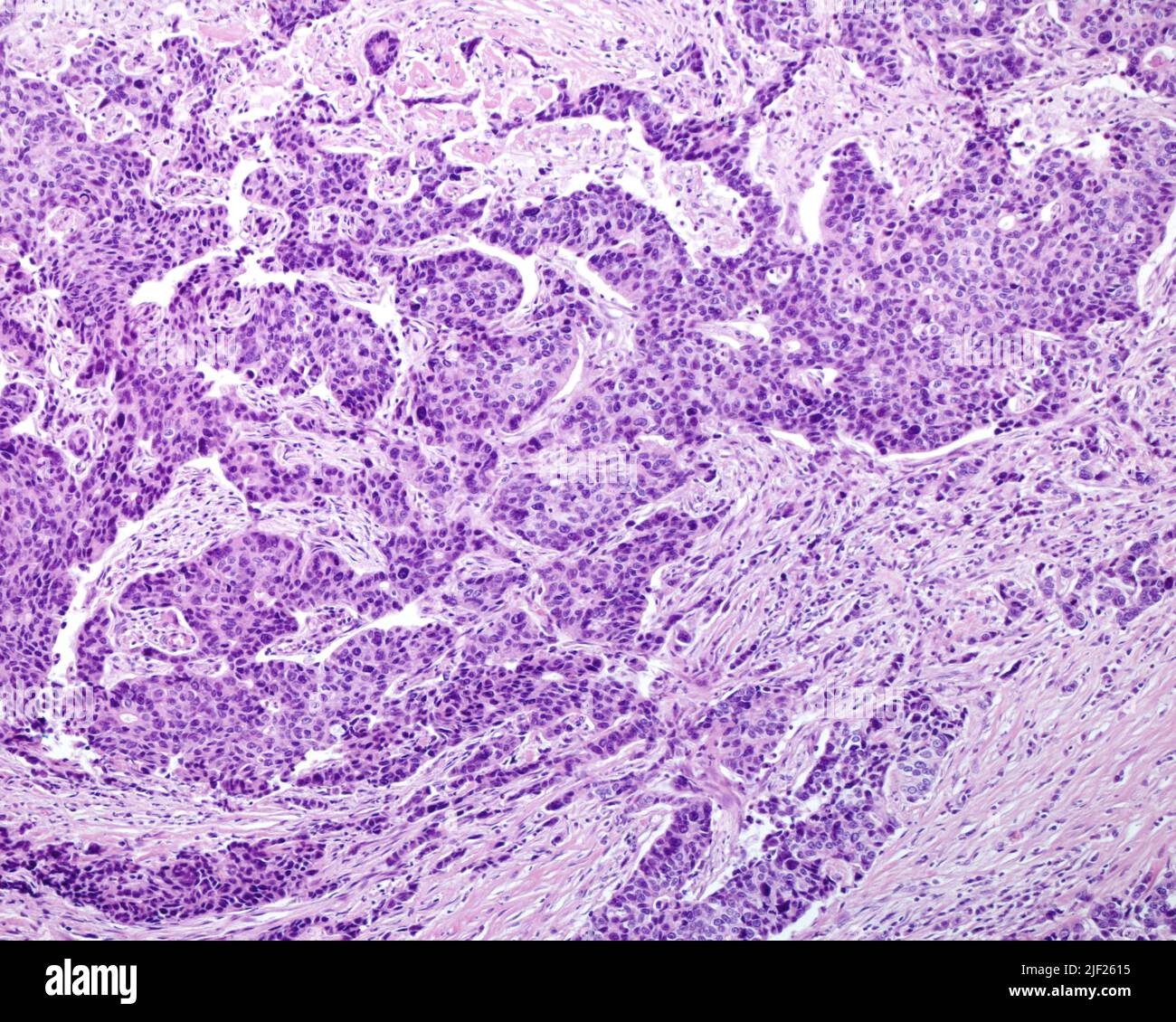 Gastric adenocarcinoma, light micrograph. Gastric adenocarcinoma is a