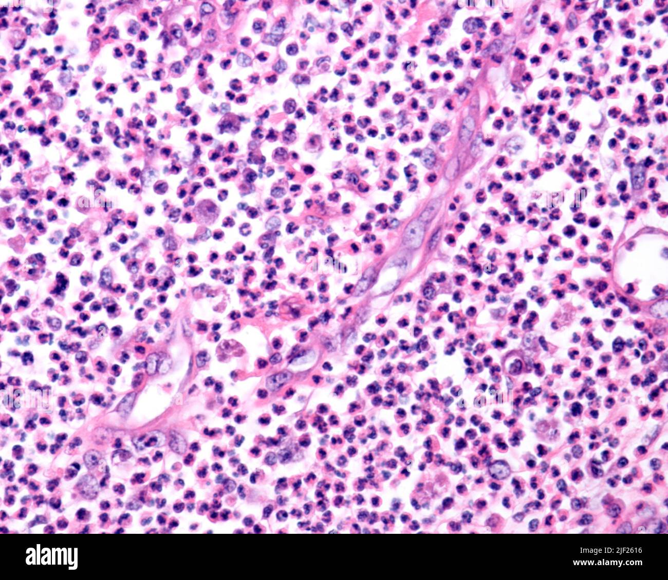 Light micrograph of pus. Pus is an accumulation of cells, white blood