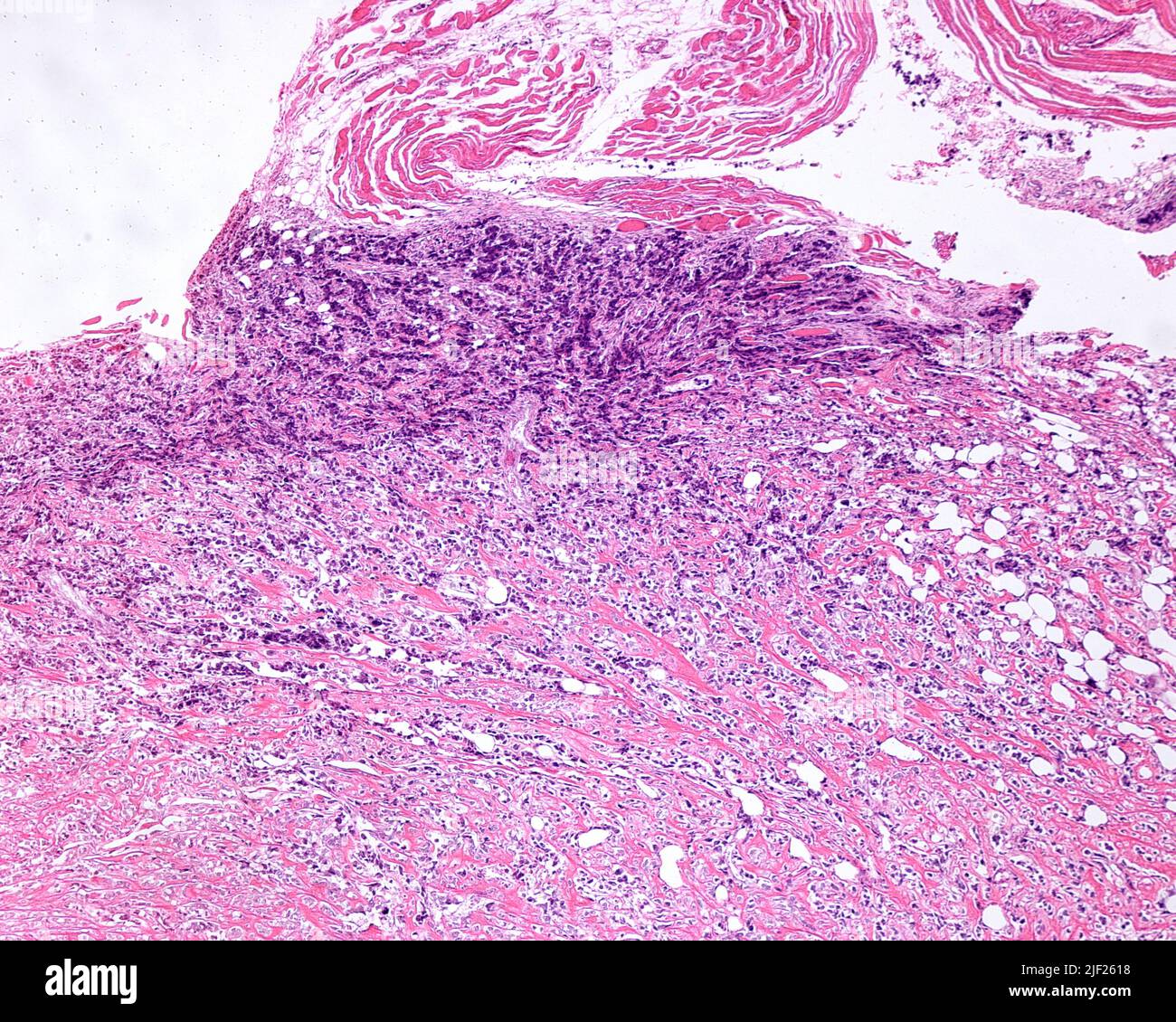 Bone cancer, light micrograph. This is an osteogenic sarcoma, the most common histological form of primary bone sarcoma, an aggressive malignant (cancerous) neoplasm. This osteogenic sarcoma is located in the bone periphery. Tumour cells invade the cortical bone producing neoplastic osteoid (bone matrix), which appears as elongated uncalcified bone trabeculae. Stock Photo