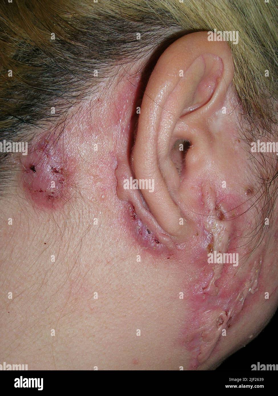 Pyoderma gangrenosum on a female patient's face. This disease causes painful ulcers on the skin. It is thought to be an autoimmune disorder, where the body's immune system attacks its own tissues. Treatment is with steroids and immunosuppressant drugs, although it can take many months for the ulcer to heal. Stock Photo