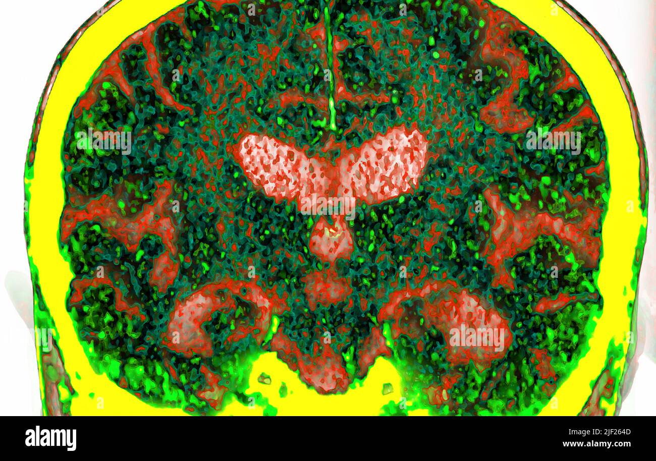 coloured-computed-tomography-ct-scan-of-a-coronal-section-through-the