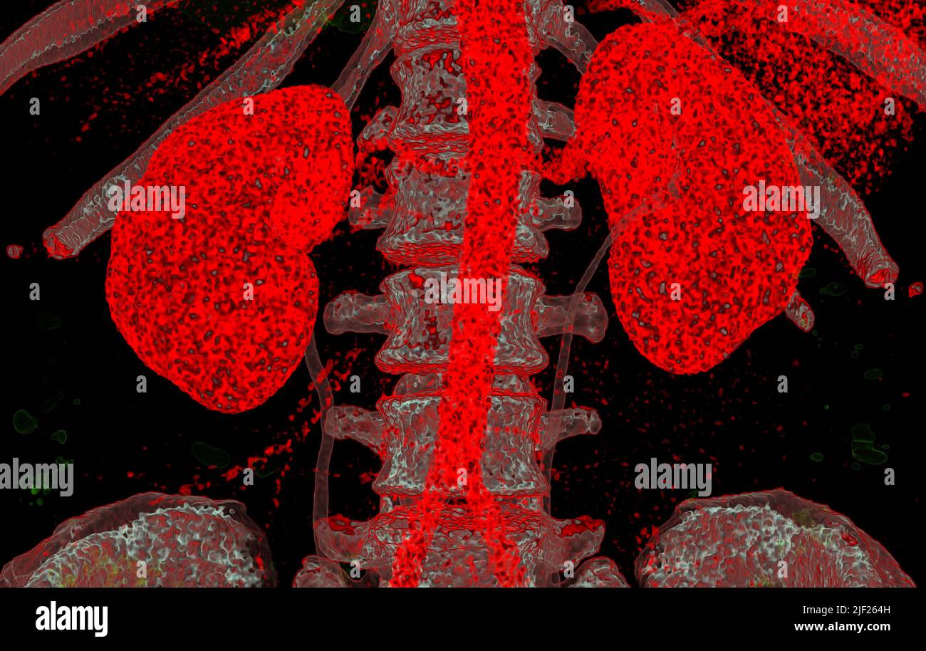 Coloured computed tomography (CT) scan of healthy human kidneys (red