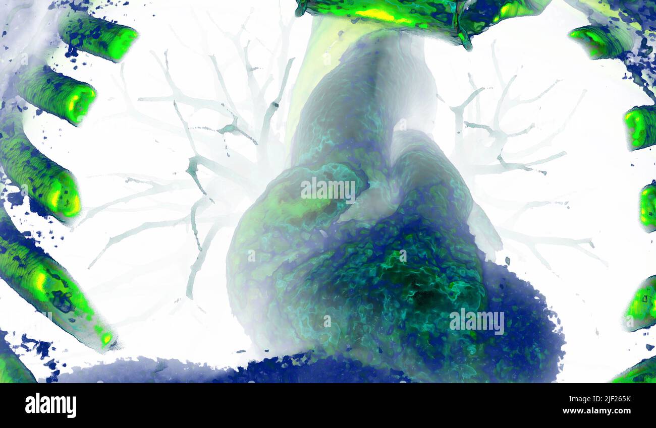 Coloured 3D computed tomography (CT) scan of a healthy heart and lungs