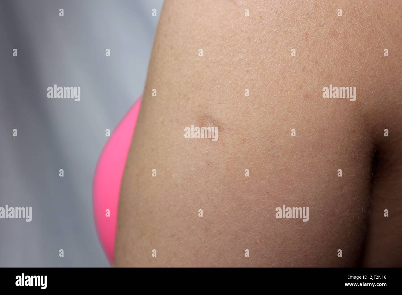 A scar from a smallpox vaccination is visible on an mature woman upper arm Stock Photo