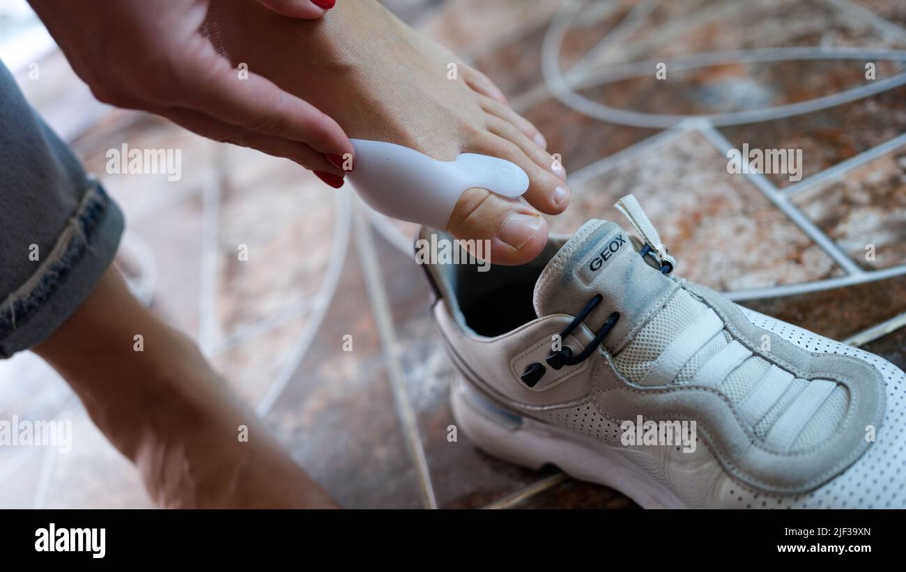 Hallux valgus on legs of woman with retainer puts on sneakers closeup Stock  Photo - Alamy