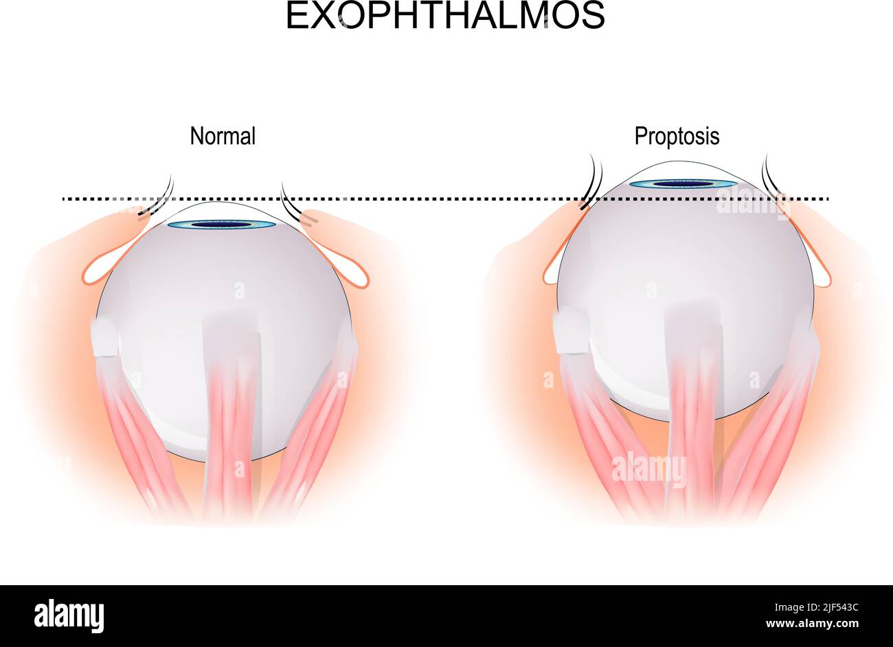 Exophthalmos is a bulging of the eye anteriorly out of the orbit. comparison and difference between normal eyeball and disorder that caused by Grave's Stock Vector