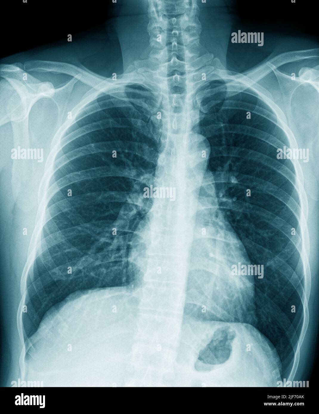 Chest X Ray Bronchitis
