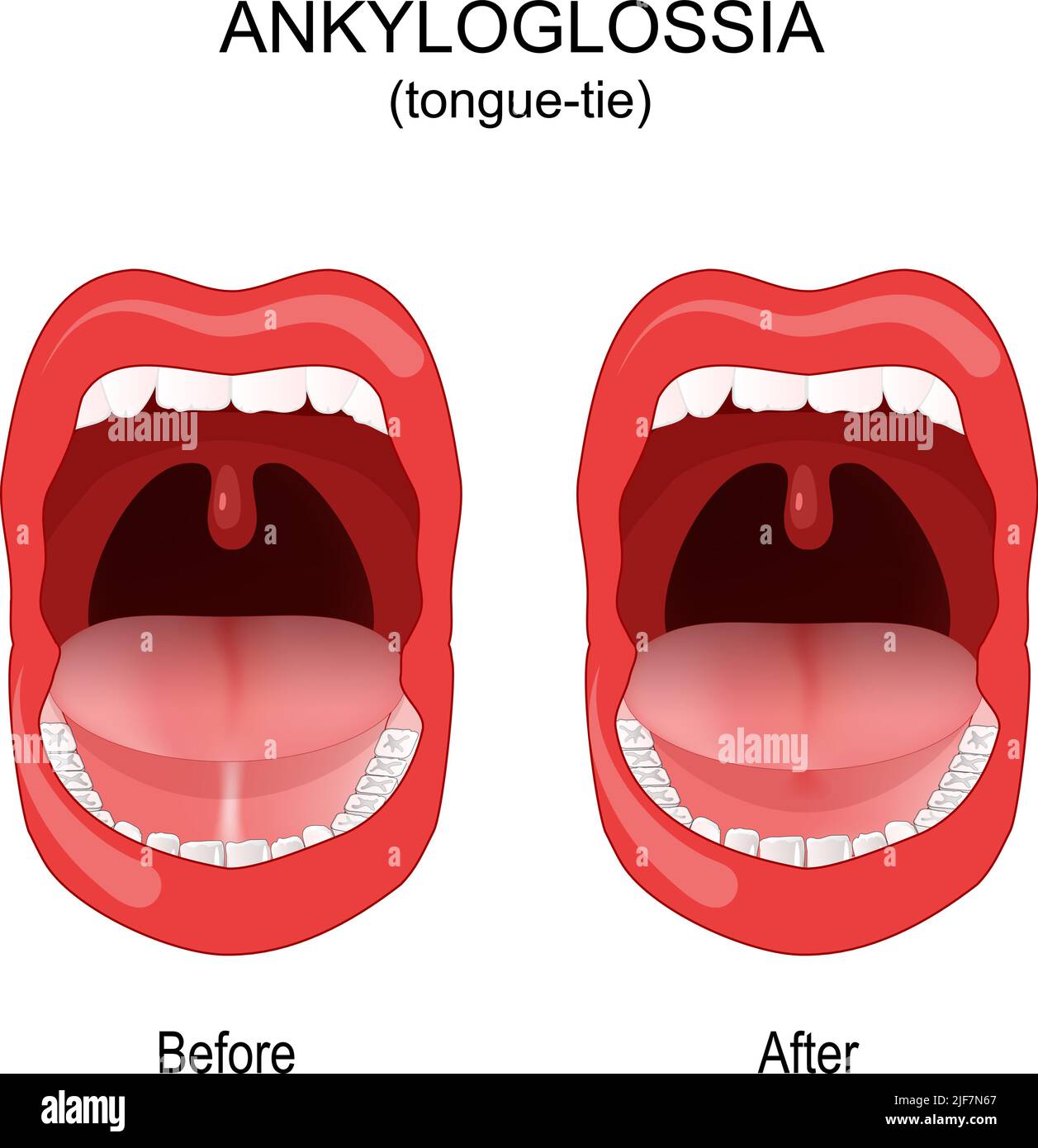 Ankyloglossia. tongue-tie. congenital oral anomaly. short, thick lingual frenulum that connecting the underside of the tongue to the floor of the mout Stock Vector