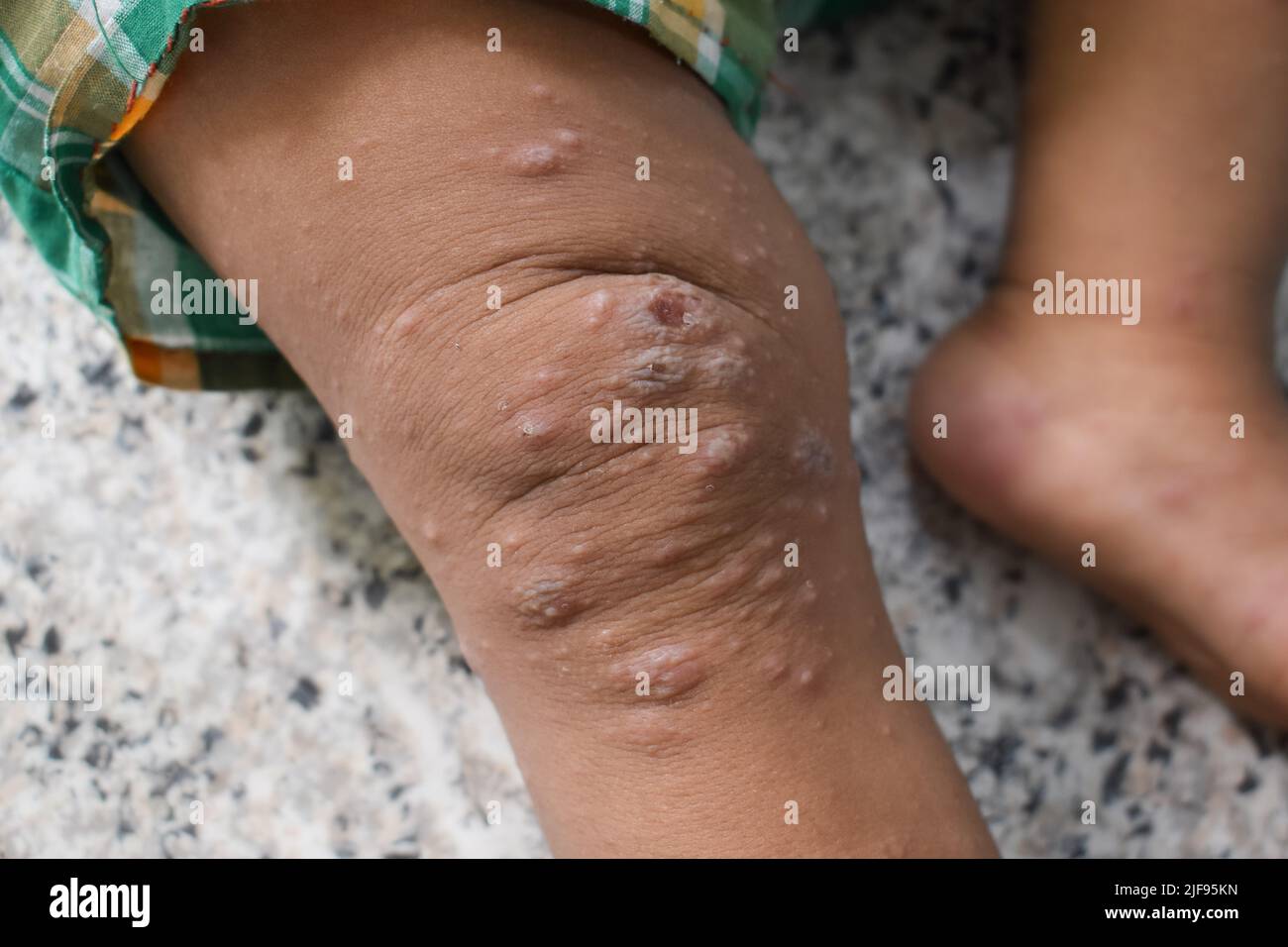 Scabies Infestation with secondary or superimposed bacterial infection and pustules in leg of Southeast Asian, Burmese child. Stock Photo