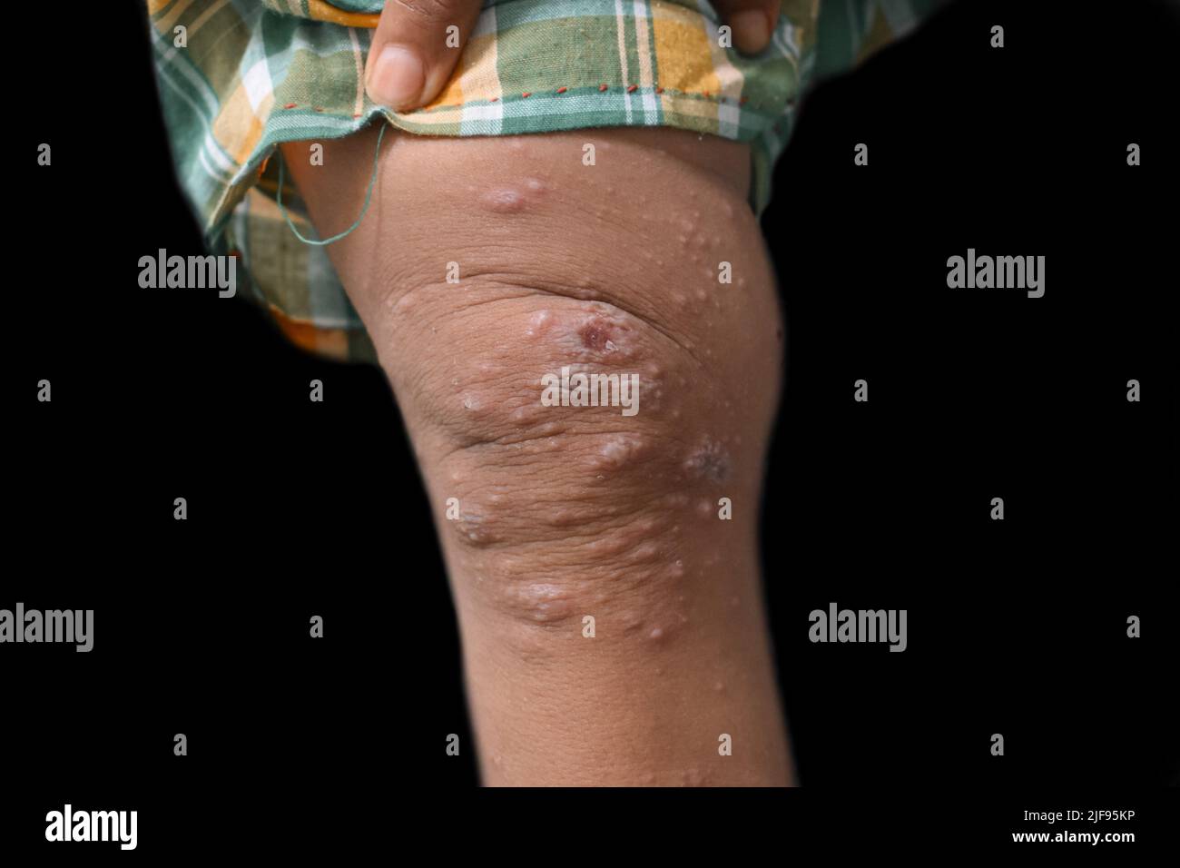 Scabies Infestation with secondary or superimposed bacterial infection and pustules in leg of Southeast Asian, Burmese child. Stock Photo