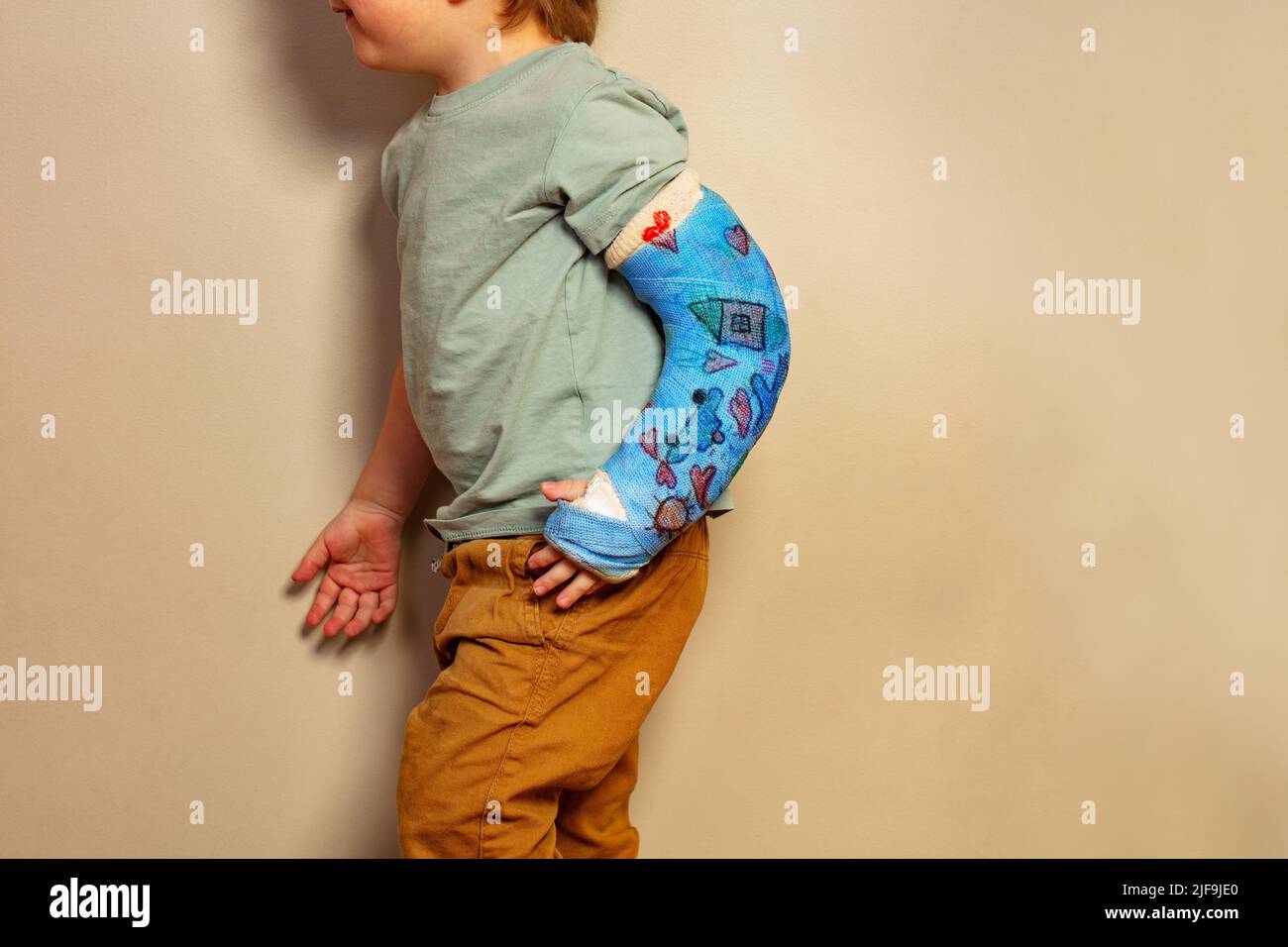Close Broken Hand Cast Little Boy Standing Wall Stock Photo by
