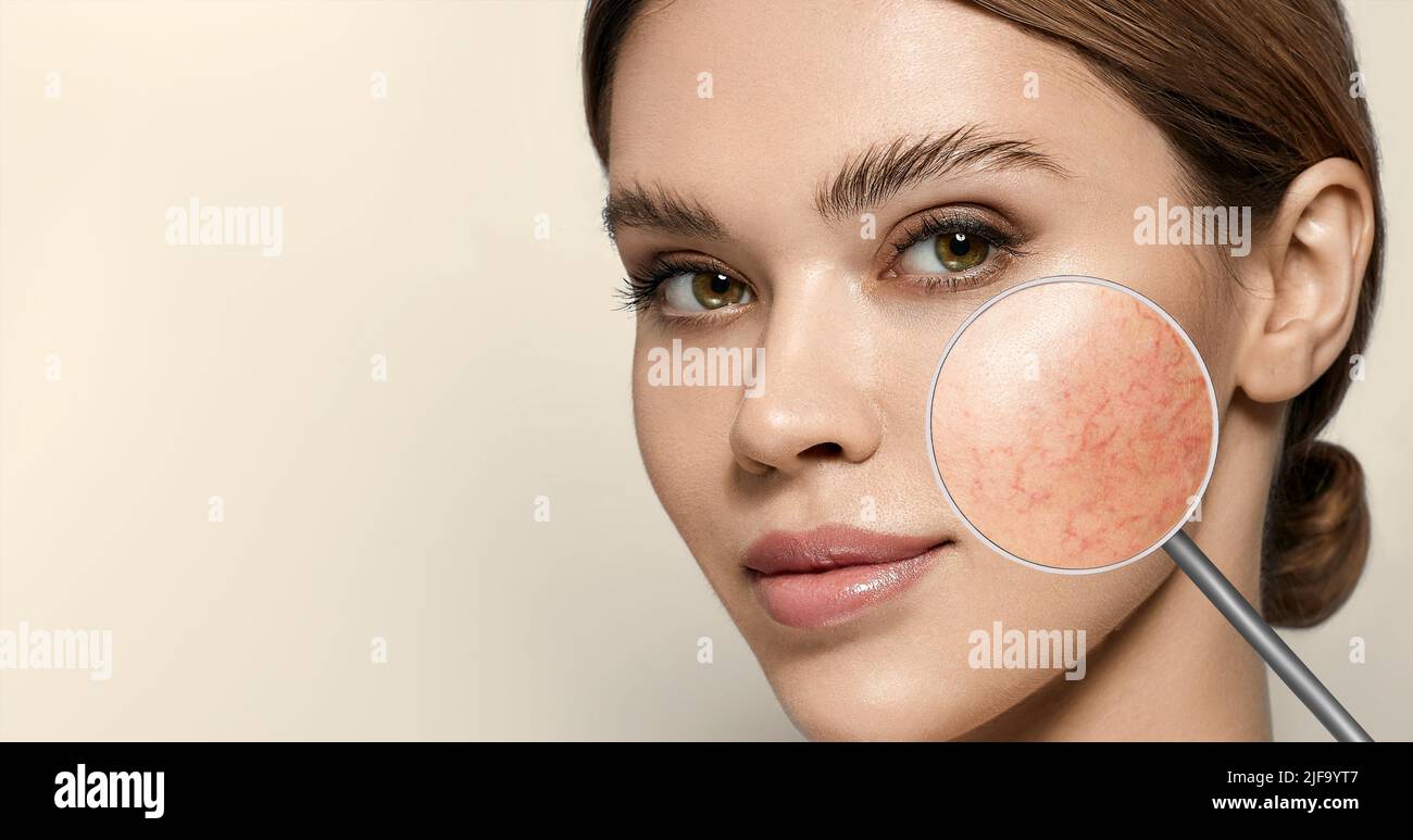 Magnifying glass showing couperose on face skin. Woman showing problems couperose-prone sensitive skin Stock Photo