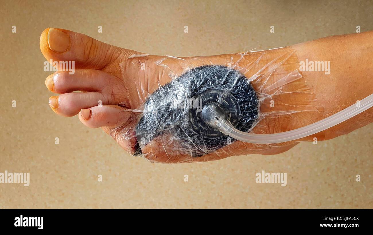 Vacuum therapy after surgery for diabetic foot syndrome, Hospital