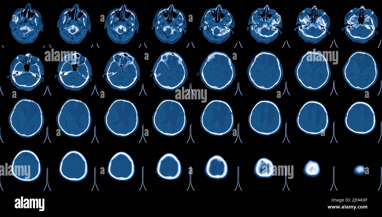 MRI scan of the brain. Magnetic resonance imaging scan. Medicine, science and education CT background Stock Photo