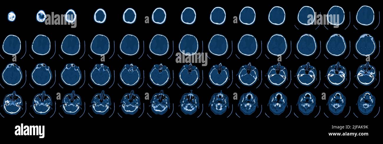 MRI scan of the brain. Magnetic resonance imaging scan. Medicine, science and education CT background Stock Photo