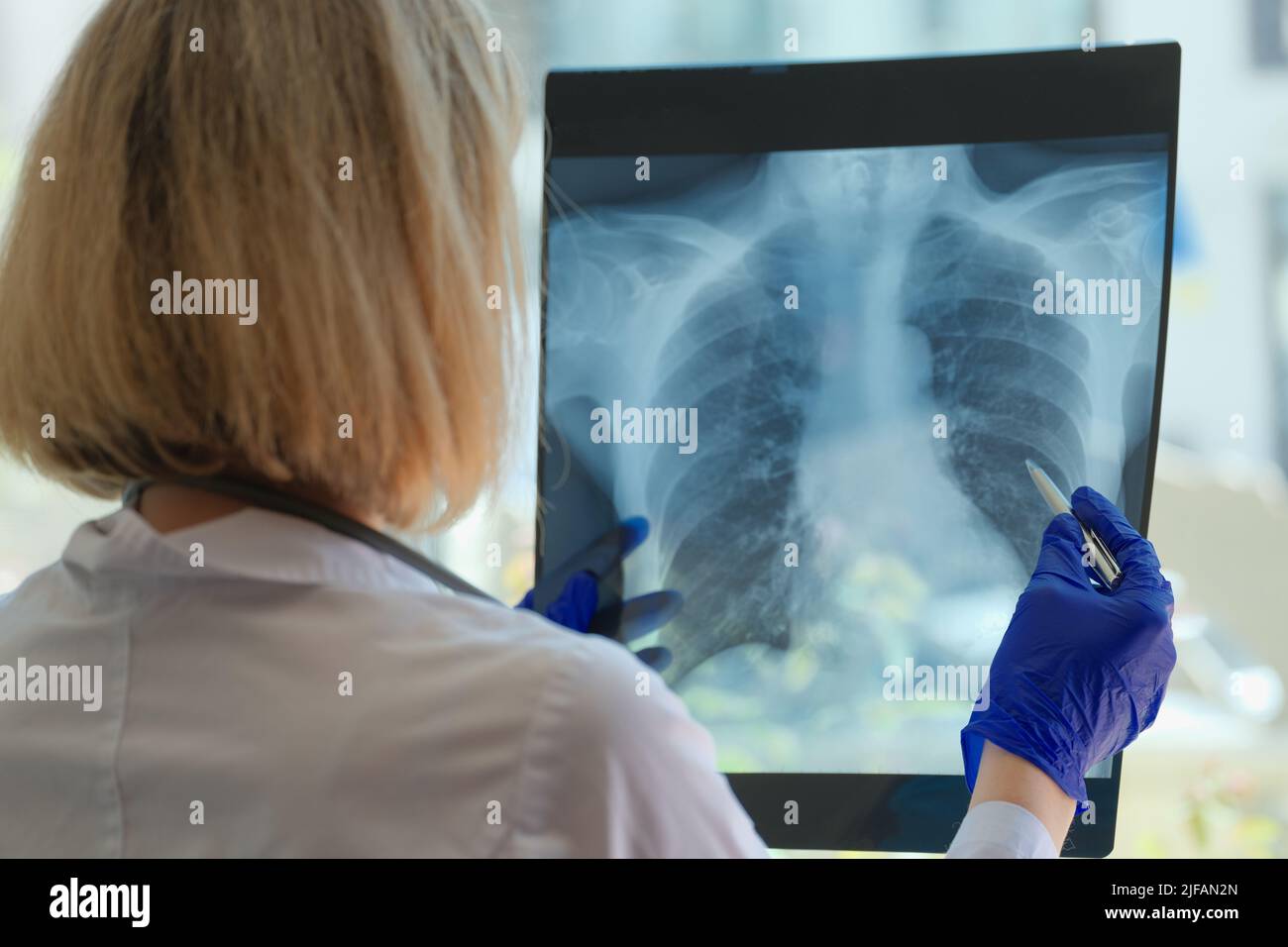 Chest x ray bronchitis hi-res stock photography and images - Alamy