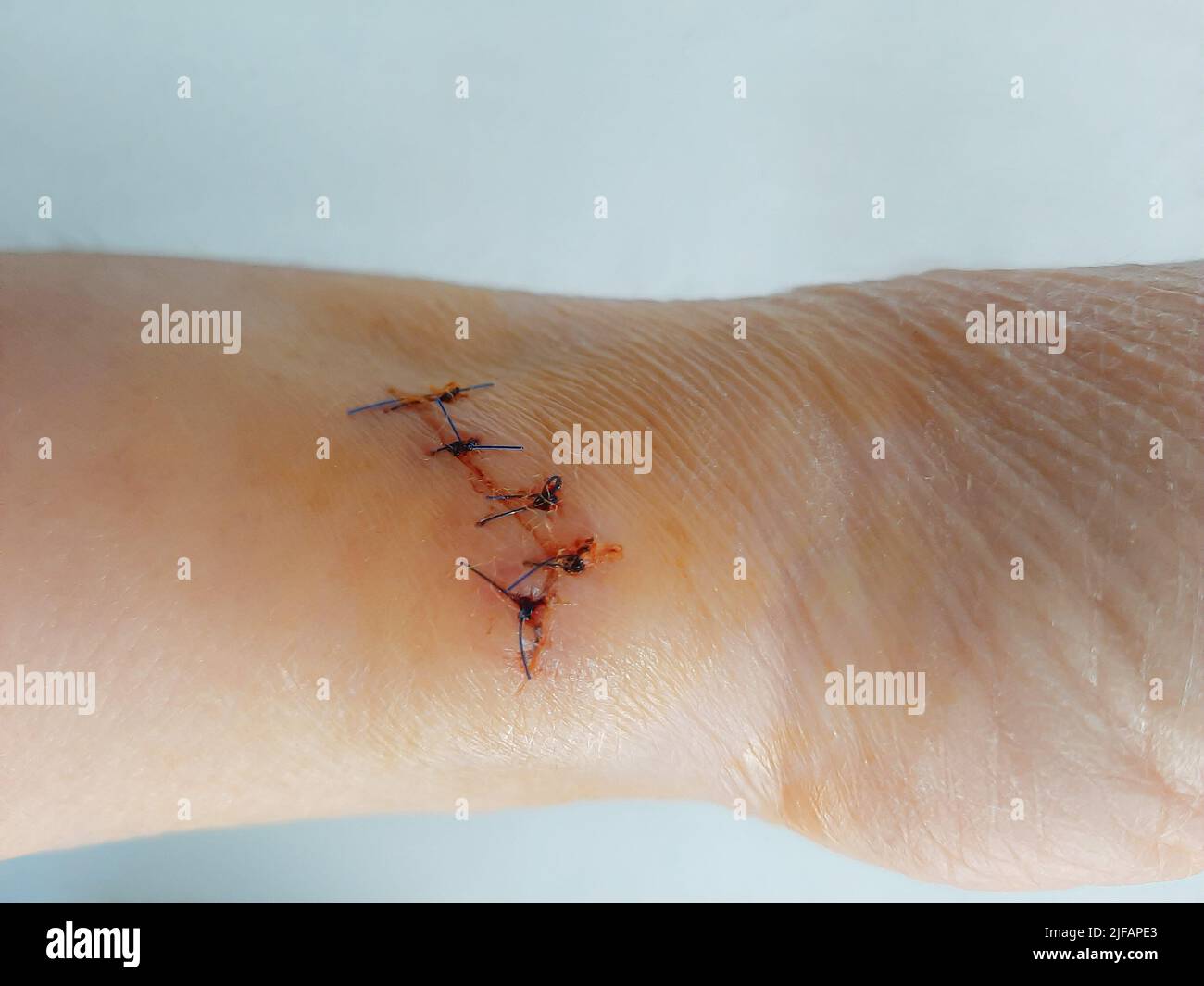 Wound and stitches on the arm of an elderly female patient, home accidents, elderly care at home Stock Photo