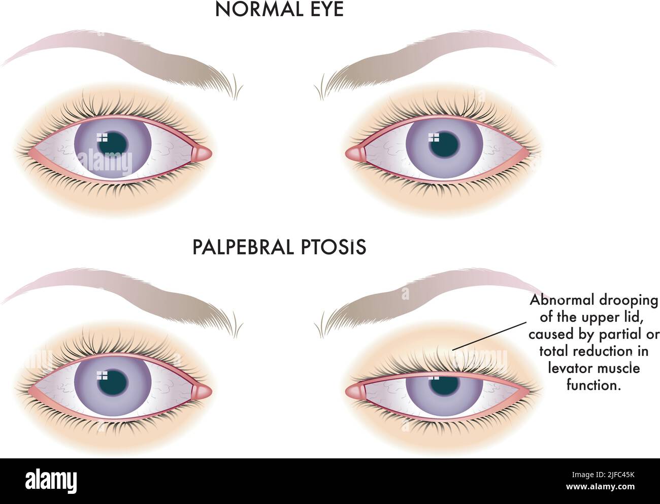 Medical illustration shows the comparison between a normal eye and one affected by palpebral ptosis. Stock Vector
