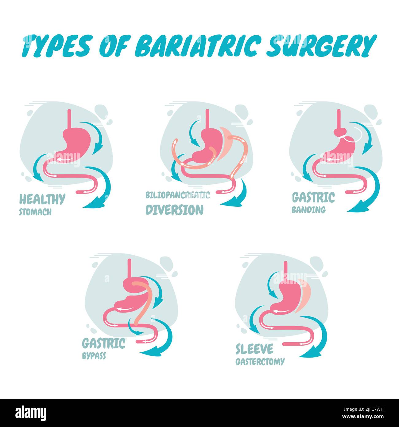 Types of bariatric surgery, it is process for the digestive system in stomach, A new types of bariatric surgery Stock Vector
