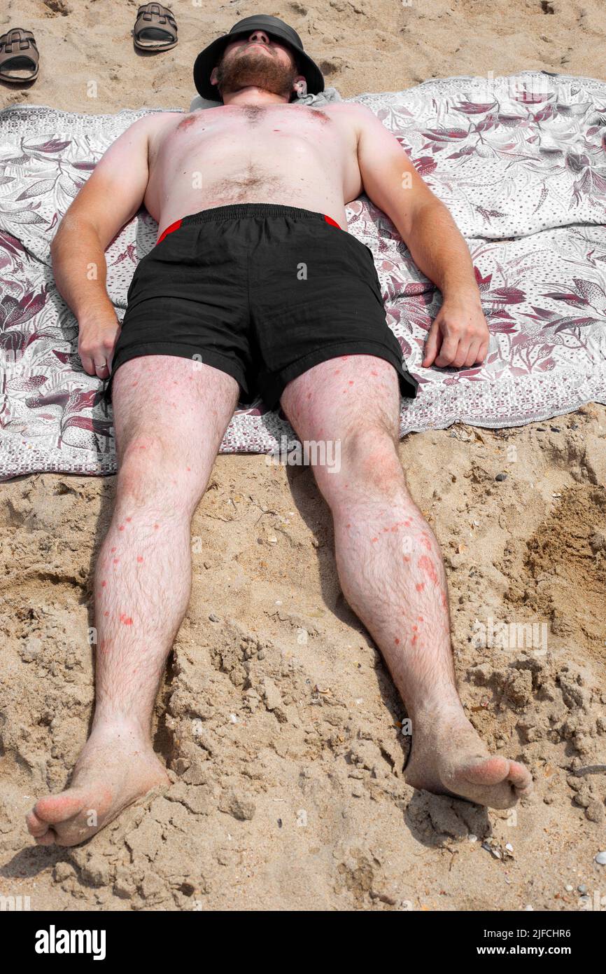 An adult man with psoriasis is sunbathing on a sandy beach. Treatment of skin diseases with ultraviolet light. Stock Photo