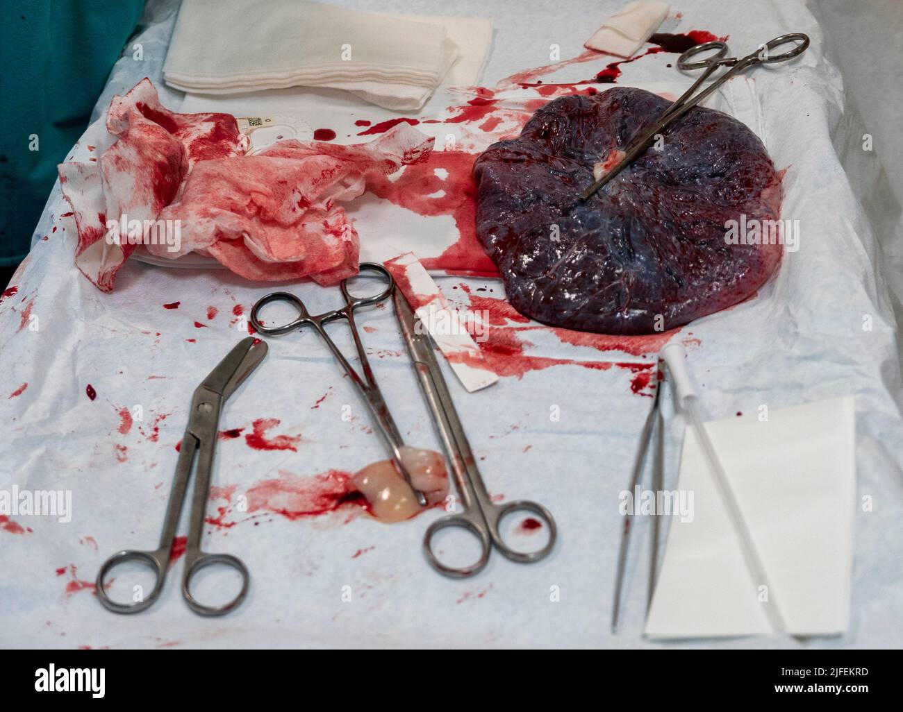 Placenta outside the uterus after childbirth Stock Photo