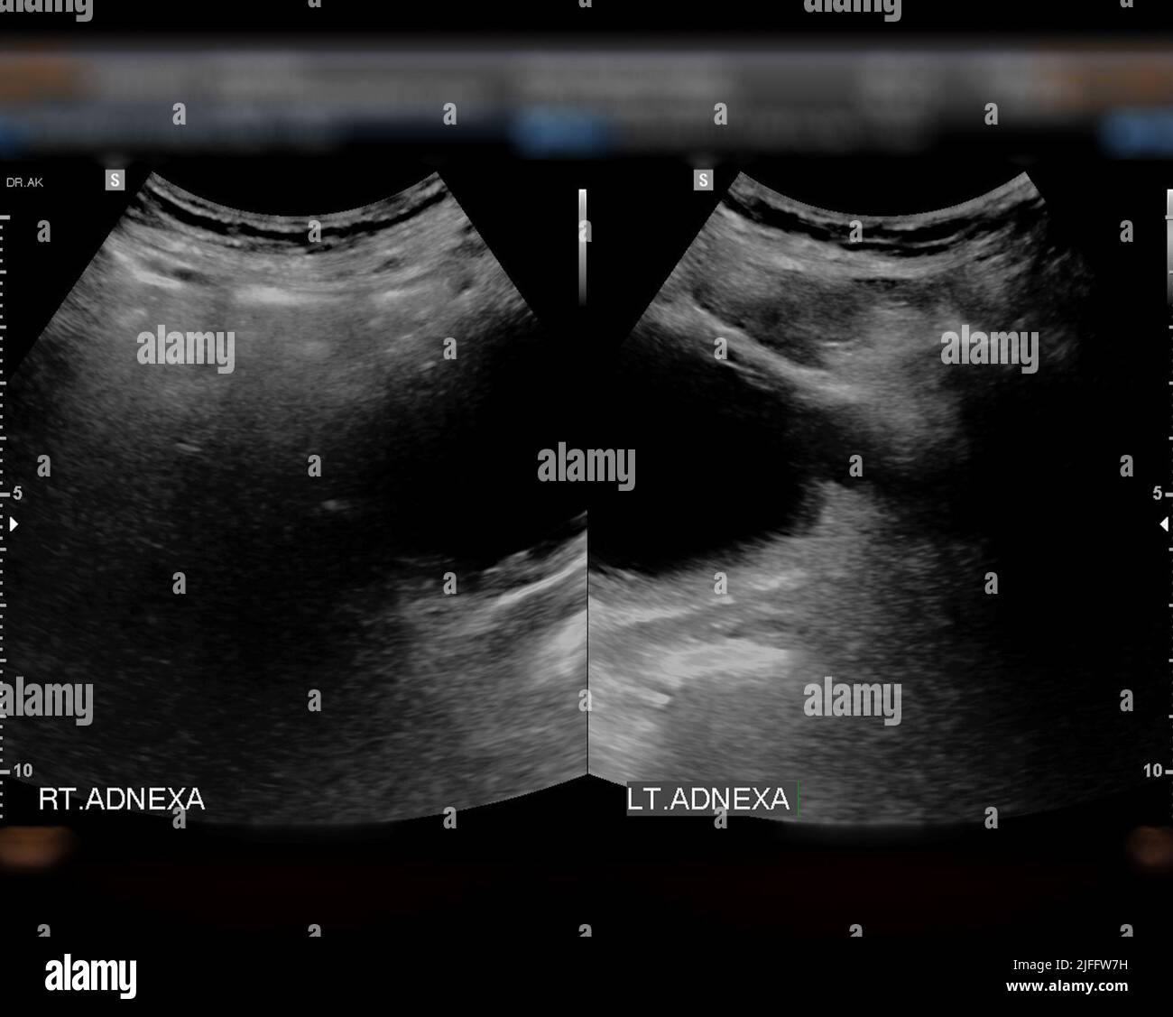 Ultrasound of urinary bladder  or KUB for  screening  renal and bladder disease. Stock Photo