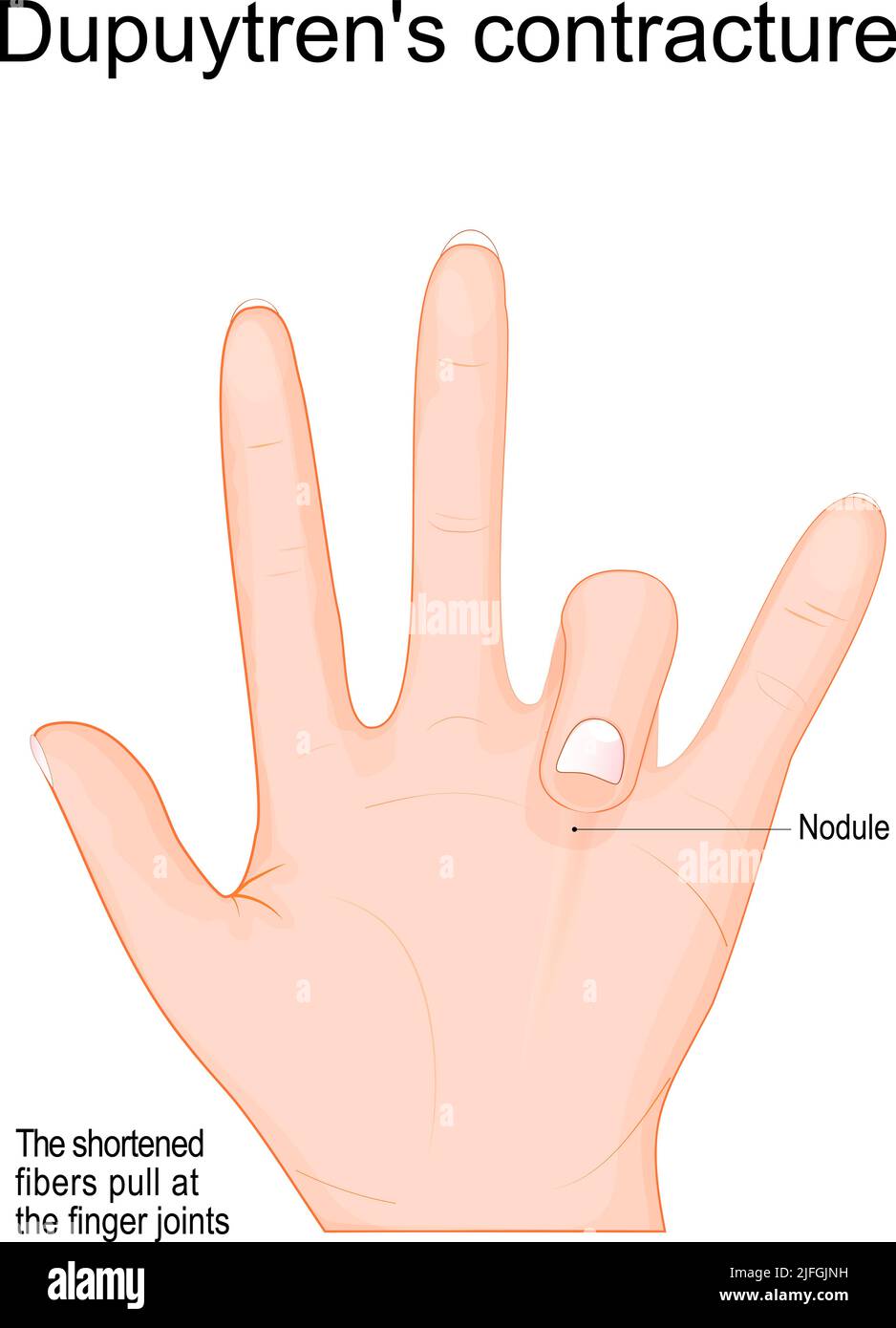 Dupuytren's contracture. finger bend in towards palm. Dupuytren's disease in left hand. fibrosing disorder that causes thickening and shorting of palm Stock Vector