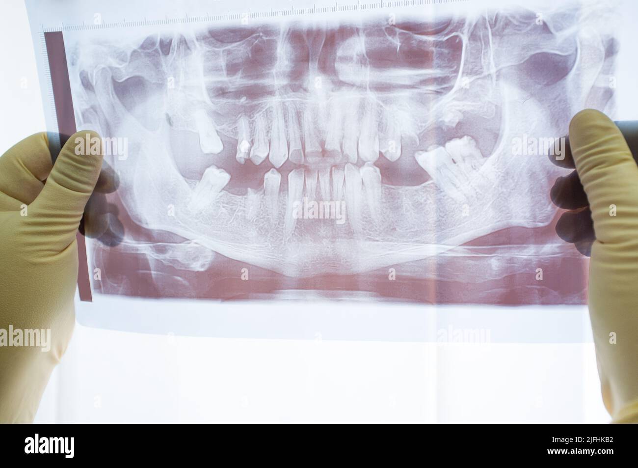 Jaw dental xray scan front view Stock Photo Alamy