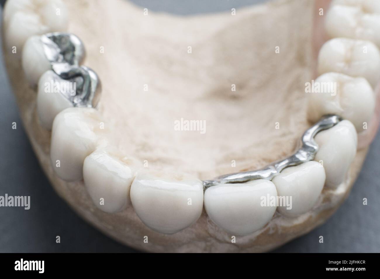 Gypsum jaw with ceramic dentures closeup Stock Photo Alamy