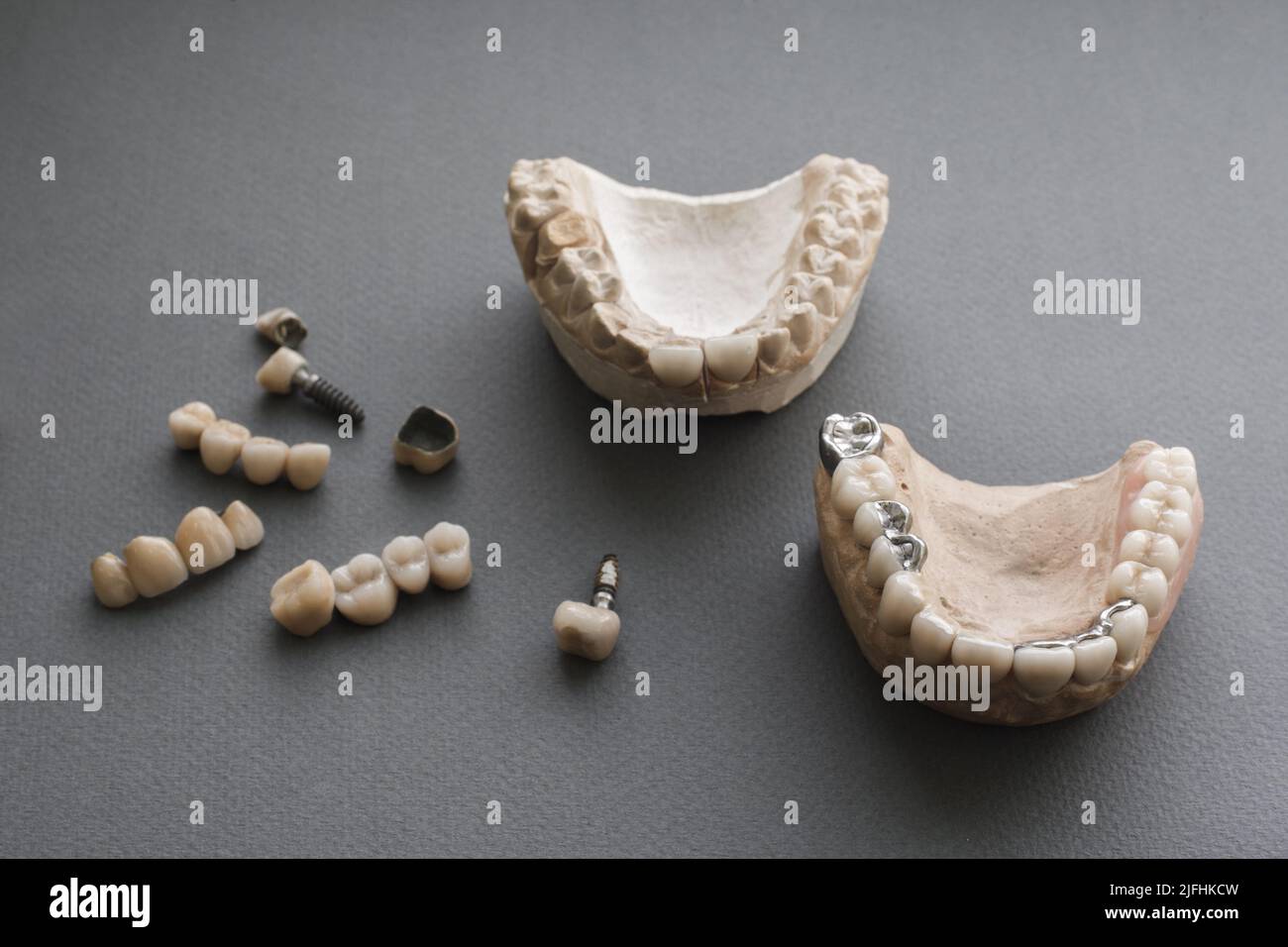 Human jaws, dental implants and crowns flat lay Stock Photo Alamy